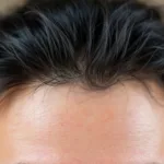 erfahren sie, welches häufige problem sich hinter juckreiz verbirgt und warum es nicht immer schuppen sind. wichtige informationen und tipps zur linderung.